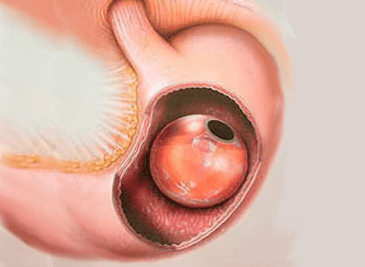 El Balón Intragástrico